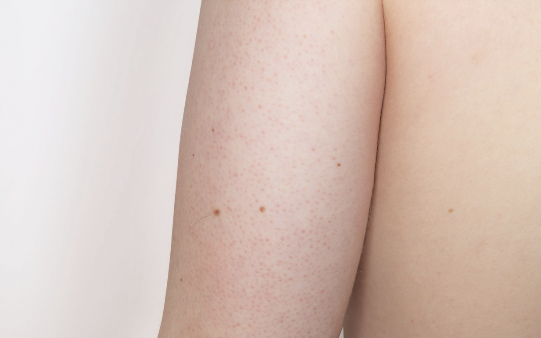 Can you undergo IPL treatment if you have Keratosis Pilaris?