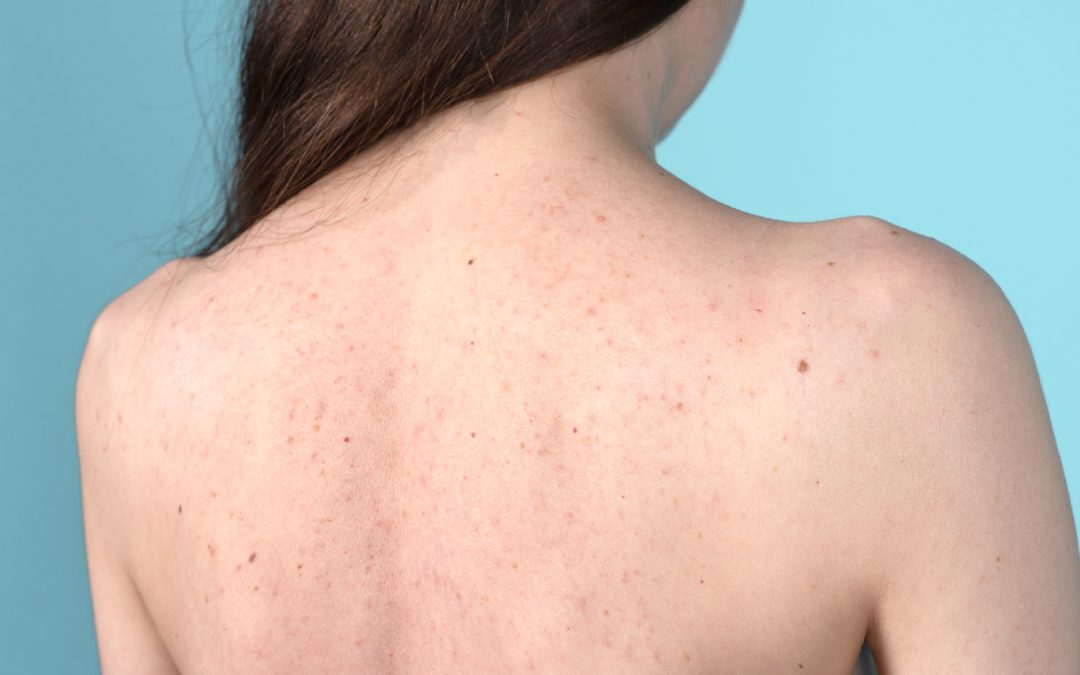 What is “Bacne” and how do you get rid of it?