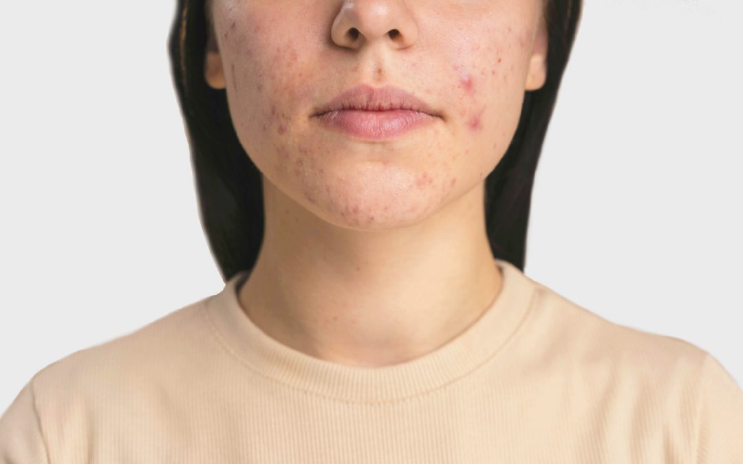 What is “Maskne” and how do you avoid it?