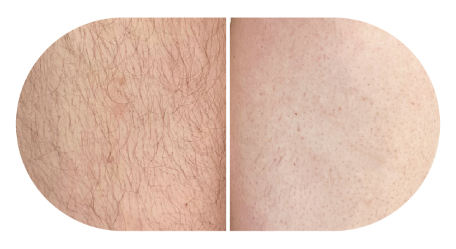 More Effective at removing fine, vellus, stubborn hair