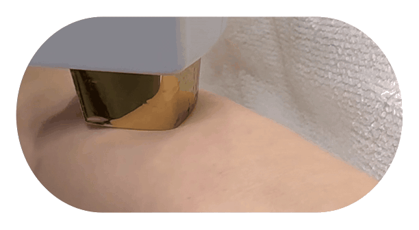 Permanent Hair Reduction Effectiveness
