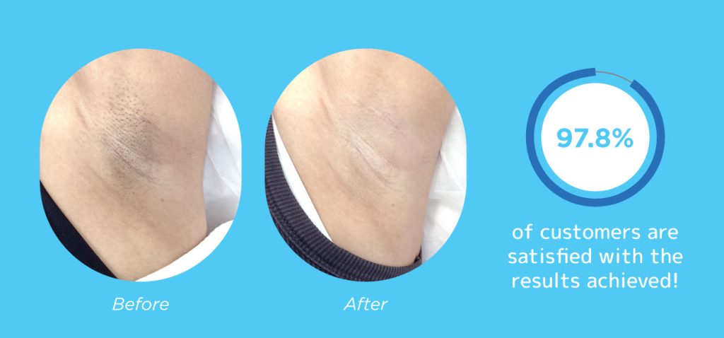 ADLight™ Hair Removal at Japan IPL Express