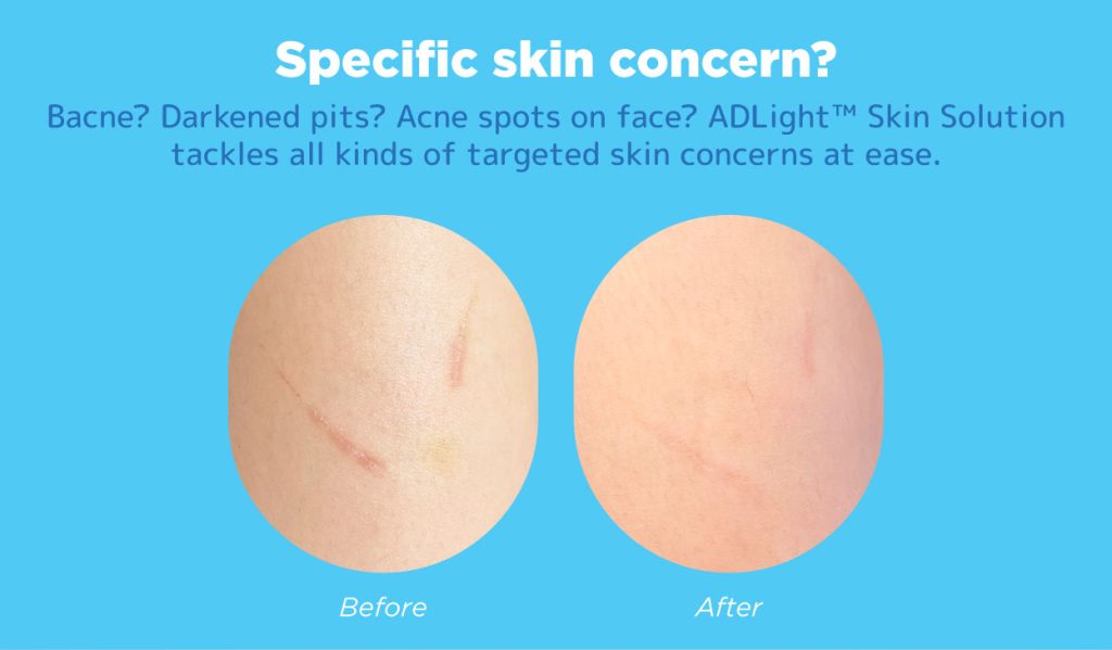 ADLight™ Skin Solution at Japan IPL Express