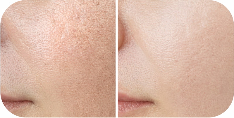 TriLight Therapy Before After at Japan IPL Express
